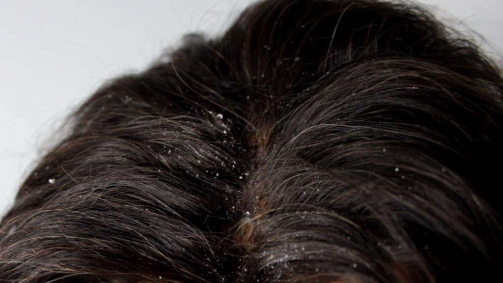 Do You Have Dandruff? What Do You Do?